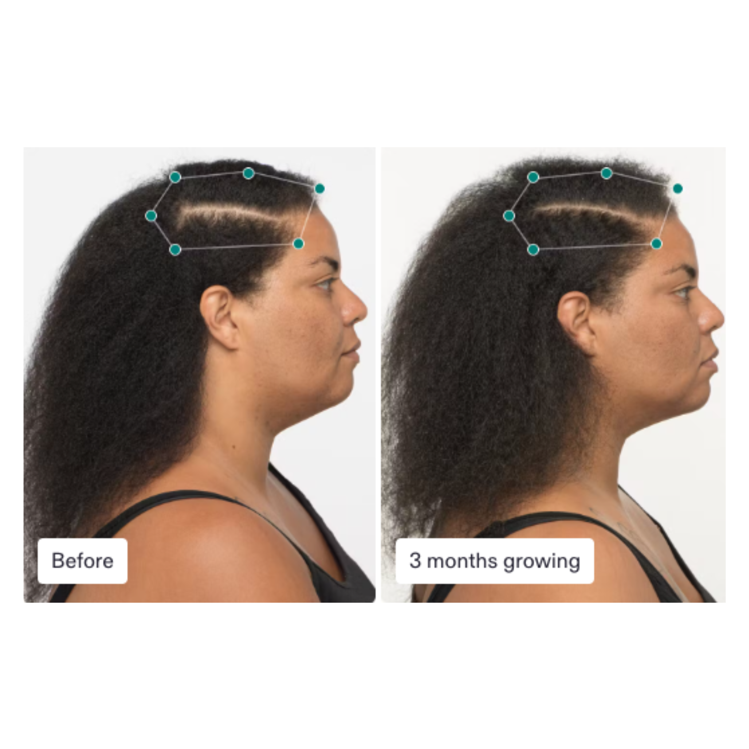 Nutrafol: Women Hair Growth Nutraceutical (3 month supply)