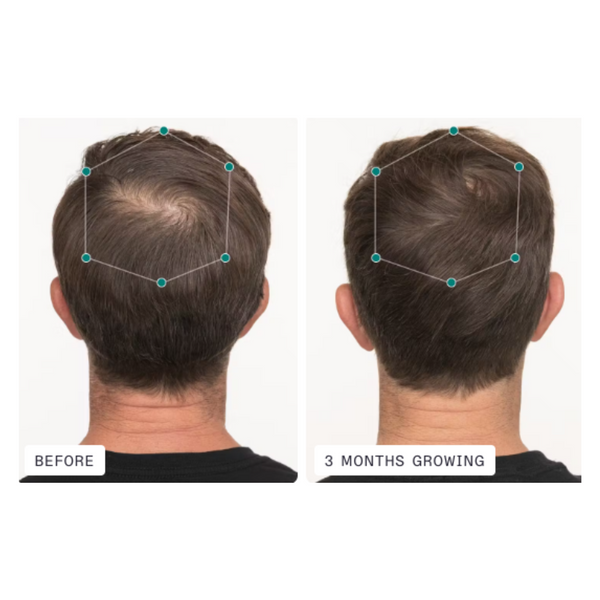 Nutrafol Men - Hair Growth Nutraceutical