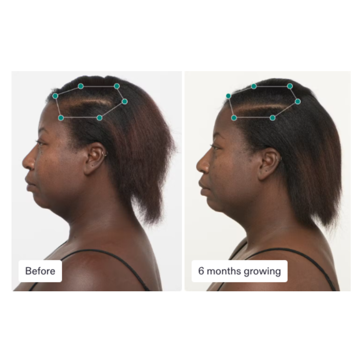 Nutrafol: Women Hair Growth Nutraceutical (3 month supply)